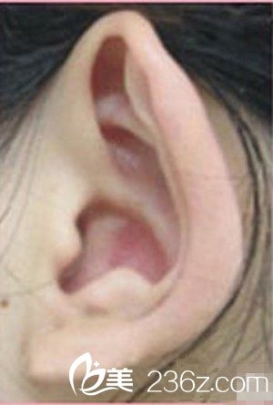“先天性双侧招风耳”实施了耳部矫正手术