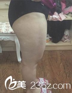 浙江省第一医院吸脂瘦大腿 浙江省第一医院吸脂瘦大腿