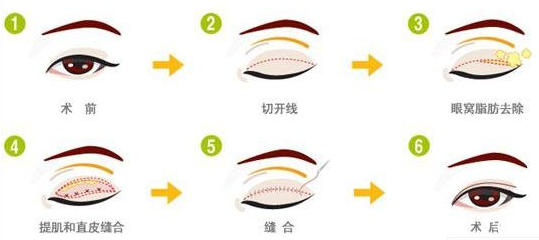 广州华美医疗美容医院做双眼皮手术多少钱?
