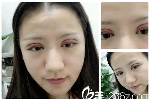 看南宁贞韩美容医院内部员工找邵菊丽医生做的双眼皮好不好