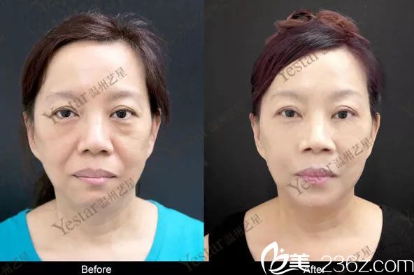 看60岁的我在温州艺兴做全脸玻尿酸填充除皱抗衰效果好吗