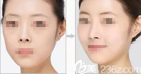 自体脂肪隆鼻是什么原理_自体脂肪隆鼻