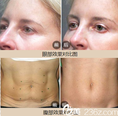 第四代热玛吉治疗效果怎么样?眼部和腹部热玛吉效果展示 第四代热玛吉治疗效果怎么样?眼部和腹部热玛吉效果展示