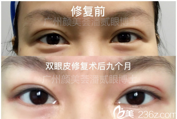 最近ins上流行起炫富新姿势假摔,在爱车前摔倒,把撒一地,均匀分布,就看谁摔得贵!可偏偏她凭那双呼之欲出的大胸在这场炫富中杀出血路!你不可否认,那些身外之物哪有圆润饱满的玉峰吸引人???很多宝宝问了,那么广州美莱做隆胸多少钱呢?效果怎么样呢?下面就就让广州美莱李高峰为大家揭秘吧~ 广州美莱做假体隆胸怎么样?