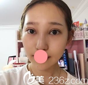 我找延吉尹世整形医院的尹庆爱医生做了韩式三点双眼皮,七天就恢复的