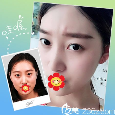 格莱美瘦脸针真人案例