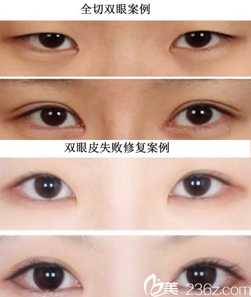 亳州市人民医院薛仰杰全切双眼皮 双眼皮失败修复案例前后对比图