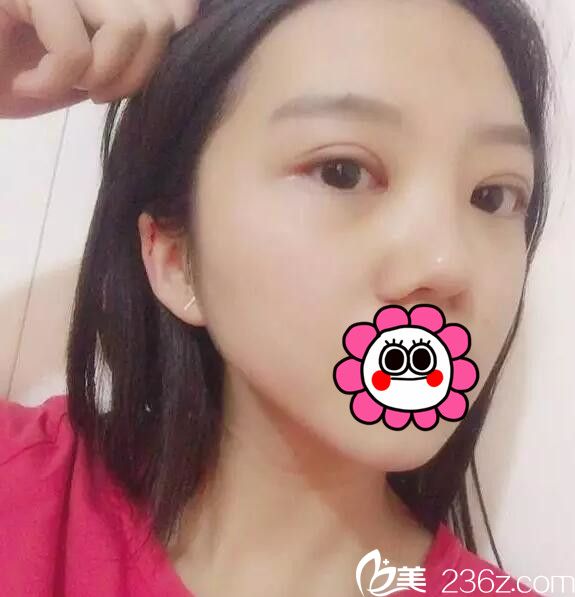 长春京典开眼角和韩式双眼皮案例