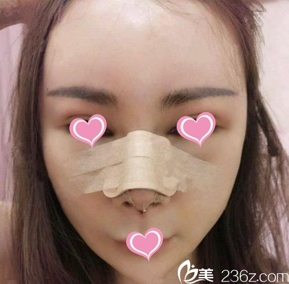 自体脂肪隆鼻是什么原理_自体脂肪隆鼻(3)