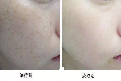 谁知道超皮秒祛斑效果好不好