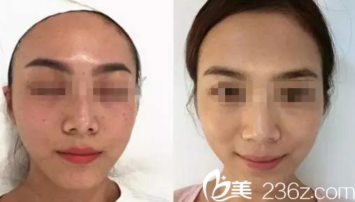 激光祛斑的危害与效果什么时候做好 20181017_1539770845868687.png