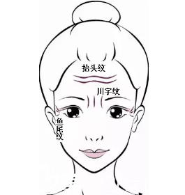 眉头有川字纹怎么办?采用botox瘦脸除皱祛除眉间纹效果明显吗