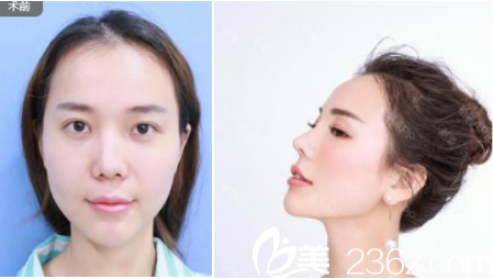 什么叫三角鼻 20181203_1543820652852535.png