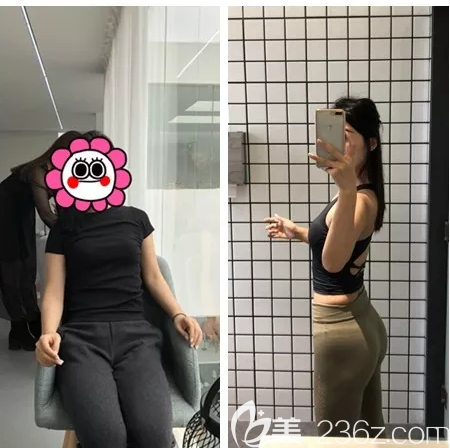 广州艺美张涛做的大腿和腰腹部吸脂案例