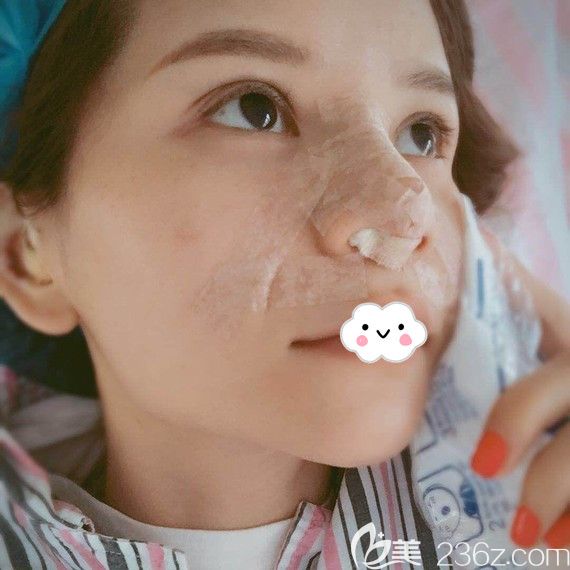 俞静假体垫鼻基底鼻小柱延长耳软骨垫鼻尖案例看武汉美丽力量鼻综合