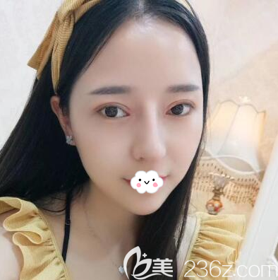 钟正强双眼皮隆鼻一个月恢复效果图 钟正强双眼皮隆鼻一个月恢复效果图