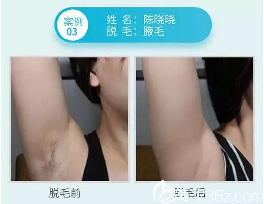 激光脱毛多少钱能一次性解决吗 20190515_1557884016342430.jpg