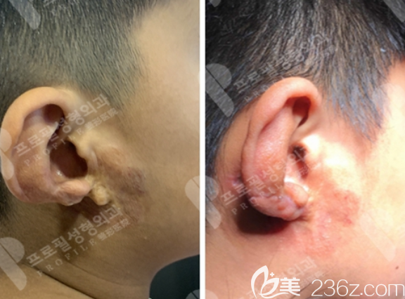 孩子耳朵萎缩8年了韩国普罗菲耳郑在皓耳朵再造让儿子终于有了耳朵