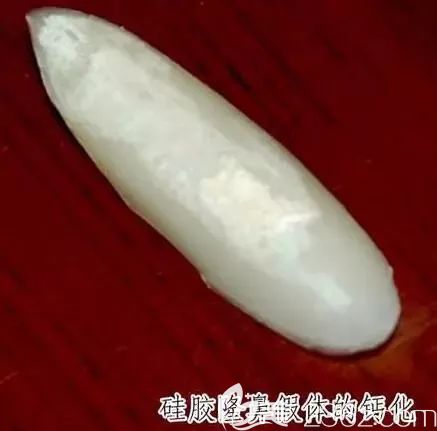 遭遇隆鼻失败后什么情况下需要取出隆鼻假体?