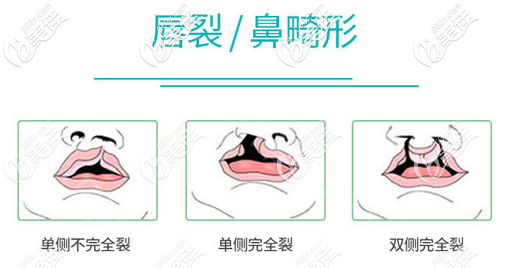 我今年20岁想做兔唇修复手术大概多少钱能完全修复好吗