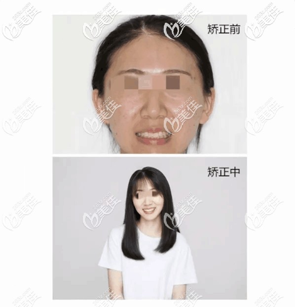 分享一哈26岁在杭州凸嘴戴牙套矫正拔四颗牙前后的脸型变化图幸好拔牙