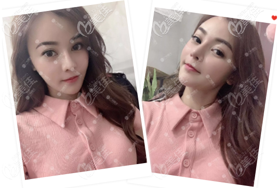 刚找王旭明做过鼻子失败修复的我比较有发言权