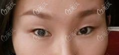 吊眼做双眼皮的效果图来看在南京地区吊眼梢割双眼皮多少钱