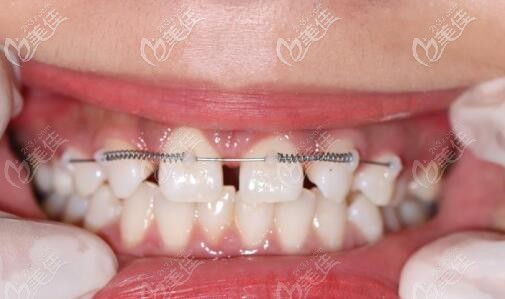 门牙缝隙大局部矫正关闭间隙又戴了全瓷牙点赞乐山安普口腔的效率