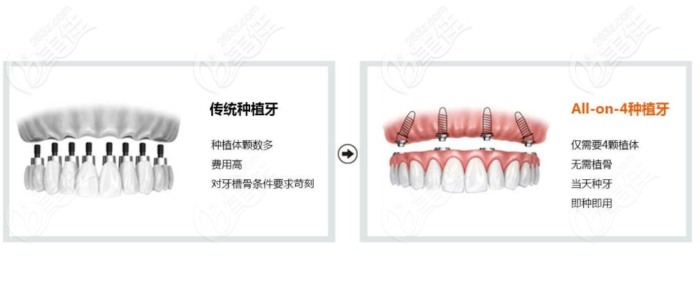 allon4即刻负重种植牙和传统种植牙技术比较