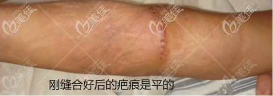 看图片了解扩张器祛疤后缝合处的疤痕是否明显和凸起