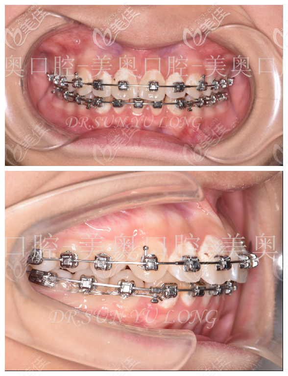 常州美奥damonq金属自锁托槽矫正病例不拔牙就能改善轻微龅牙前凸问题