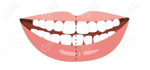 听说牙齿中线不齐造成的脸歪偏移很难调是真的吗?