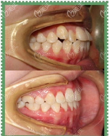 正畸一般内收几毫米骨性龅牙做隐适美牙齿矫正内收3mm改善凸嘴效果