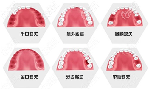 牙齿缺失先做矫正是比较常见的