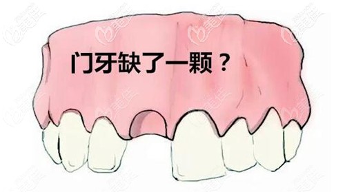 门牙缺失戴隐形义齿能用多久?可以长期戴吗?
