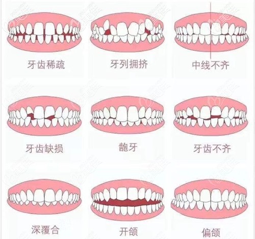 维乐口腔牙齿正畸可以改善的牙齿类型