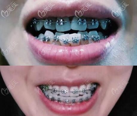武汉固齐口腔陈键金属托槽牙齿矫正案例效果对比图