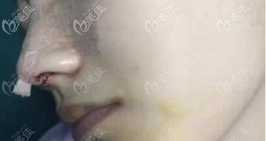 鼻子里的奥美定取了一次取不干净有残留,我摆脱奥美定