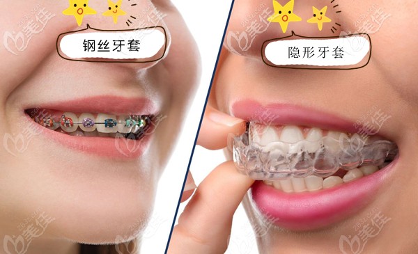 矫治牙齿选透明牙套和钢丝牙套哪个效果更好些