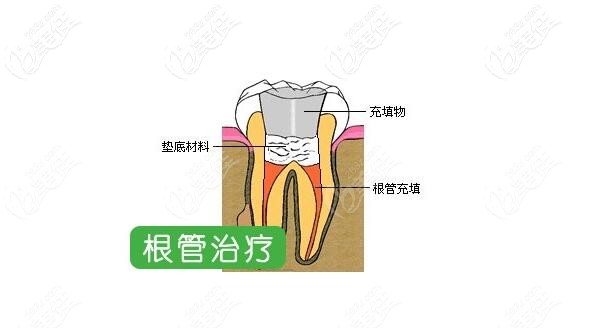 上海医院做根管治疗要多少钱一颗这收费标准可一点都不鸡肋