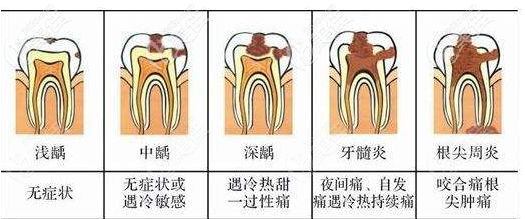 龋坏后补了牙的牙齿还会烂到牙髓么?烂透了的话要做根管治疗吗?