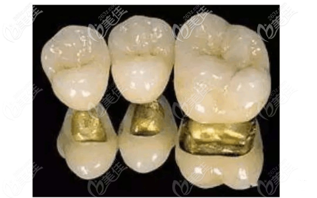 种植牙牙冠一般选哪种?牙冠材料和种类选择指南来喽