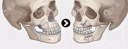 牙槽骨截骨内推的手术原理