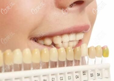 牙齿发黄牙缝大,想美白牙齿做烤瓷牙好还是牙贴面好?