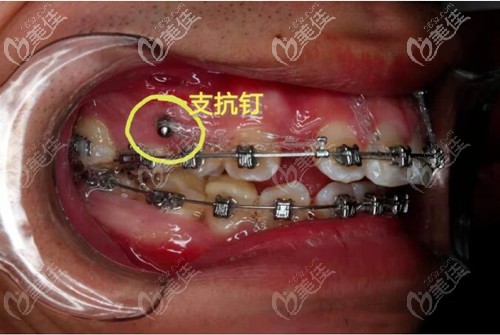 做舌侧整牙支抗钉要带多久?