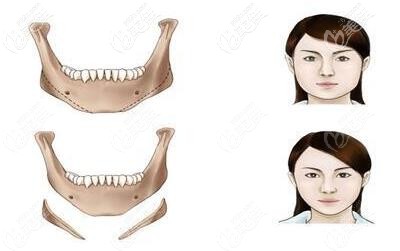 怎么判断是骨性发腮如何避免面部发腮