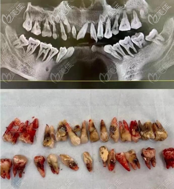 龋齿只会坏掉一颗牙,而牙周病会导致一排牙齿脱落,这也就是为啥才20多