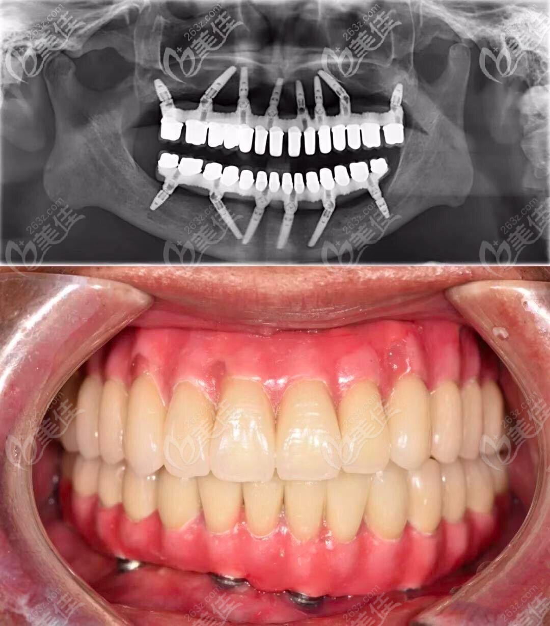 就可以恢复半口/全口牙齿的咀嚼功能,相比传统的活动假牙,种植牙很像