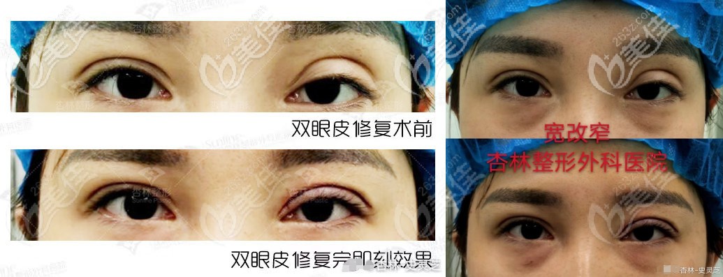 沈阳史灵芝医生做宽改窄双眼皮修复案例对比