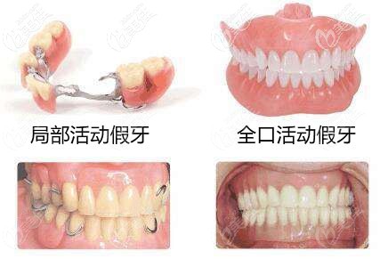 常用的活动假牙有几种材料,若做全口义齿选哪个材质好